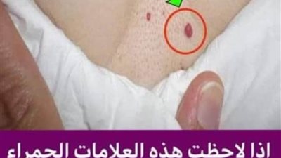 اذا لاحظت هذه العلامات الحمراء على جسمك  وخاصه على صدرك فذهب للطبيب فورا