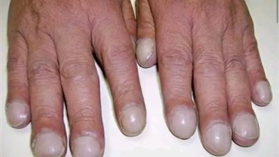 4 علامات في يديك تشير إلى مشكلة صحية في الكبد