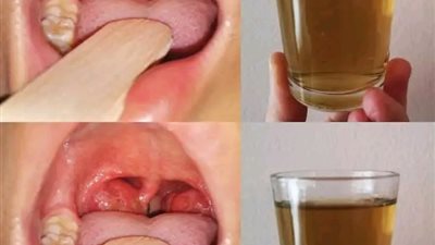 إذا كان حلقك يؤلــــمك يوجد به التهــــابات او كـــحة وبلــــغم مُـــزمن ... فعليك بهذه الوصــفة فعـــالة ومُريــحة جدا