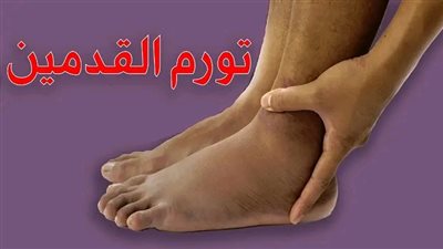 احذر أشهر أسباب تورم القدمين المفاجئ وطريقة علاجه منزليا!
