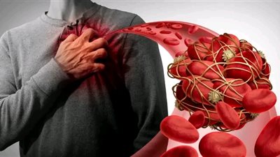 علامة في عينك تدل على ضيق شديد في شرايين القلب.. 