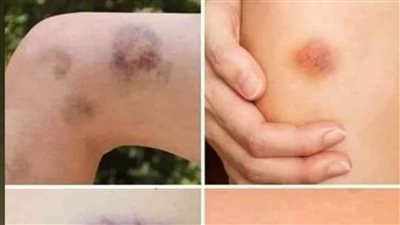 التجلطات !علامات مرضية صامته تدل على وجود جلطات بالجسم 