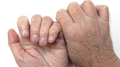 عـلاج تقشف اليدين بالطـرق الطـبيعية