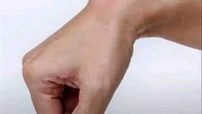 علاج الكيس الدهني بدون جراحة