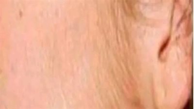 إزالة شعر الوجه بوصفات تجعله لا ينمو بارز وبكثره مرة أخرى