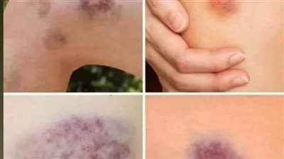 احذر من هذه التجلطات إليك علامات مرضية صامتة تدل على وجود جلطات بالجسم دون أن يشعر الإنسان