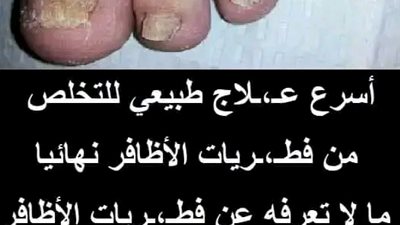 اسرع علاج للتخلص من فطريات الاظافر