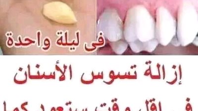 صدق أو لا تصدق إزالة تسوس الأسنان في اقل وقت ستعود كما كانت في ليلة واحدة من ثواني